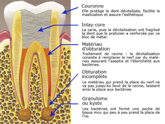 granulome dentaire